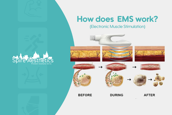 EMS treatment for post pregnancy weight loss treatment Southall