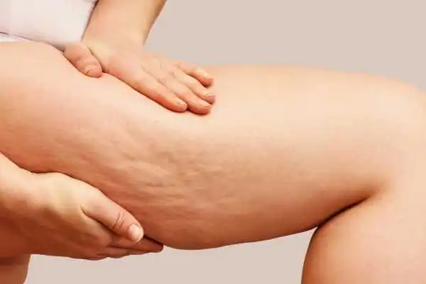 Image of woman showing leg with cellulite Southall
