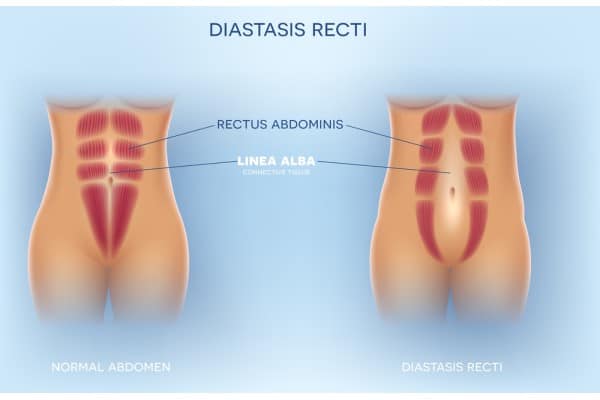 What Non-Surgical Options Are Available for Diastasis Recti Southall?
