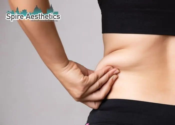 Image of woman pinching fat on their hips Southall. Fat Freezing treatment