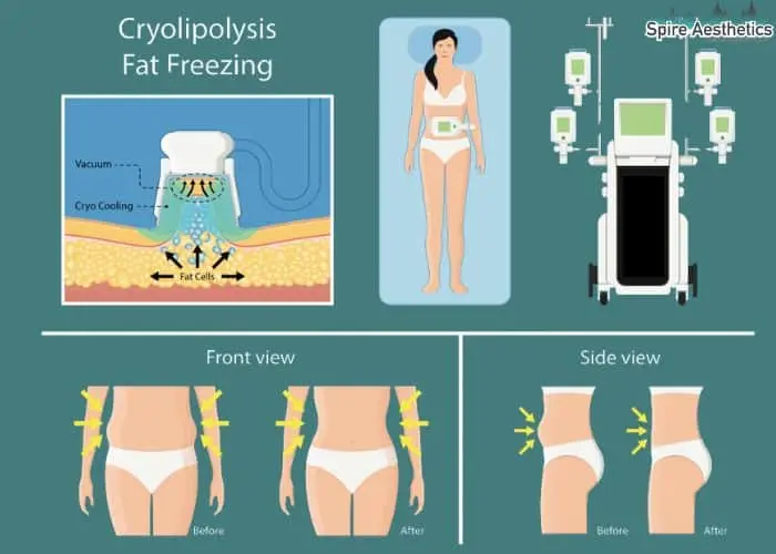 Fat freezing treatment Southall benefits for competitions to remove stubborn fat deposits.