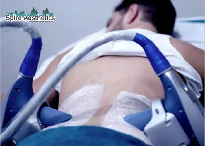 Man having fat freezing treatment done on love handles before a competitions Southall to create a sculpted look.