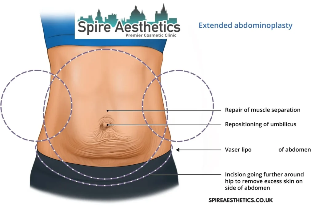 Understanding Loose Skin After Gastric Band Southall Surgery and HIFU Treatment 