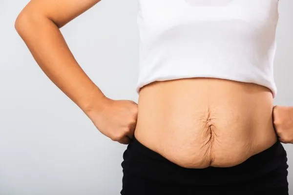 Image of a woman's stomach after weight loss with sagging skin following a gastric band Southall