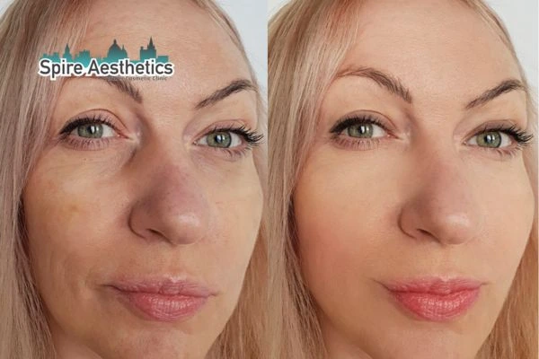 Morpheus8 Treatment Southall Before & After Results