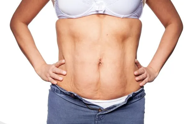sagging skin on woman's stomach after weight loss injections Southall