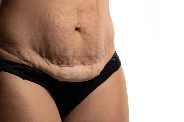 Image of womans stomach after weight loss injections Southall showing saggy skin