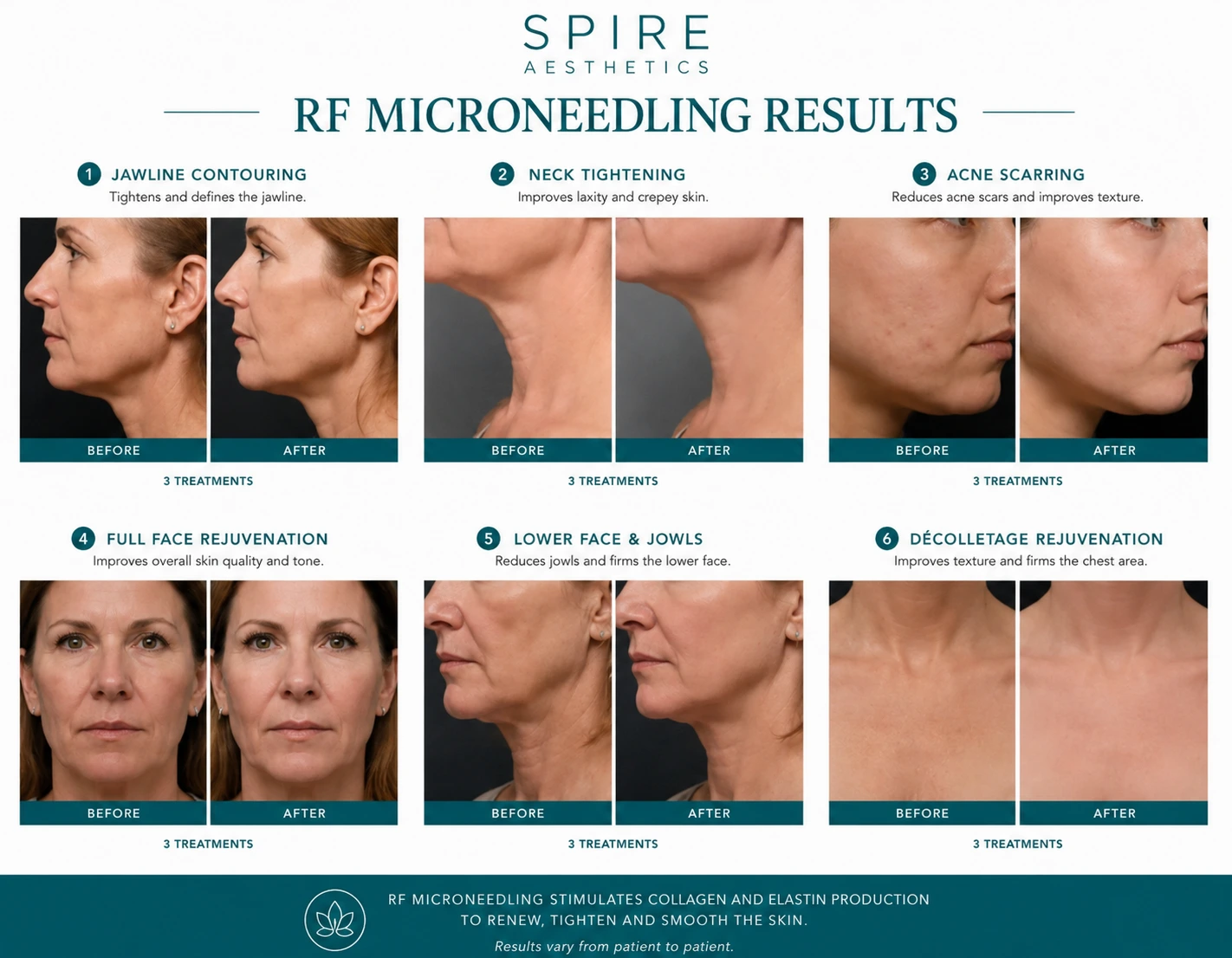 RF Microneedling Skin tightening Southall results