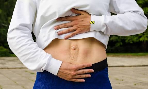 When Could Diastasis Recti Be the Missing Piece of the Puzzle Southall?