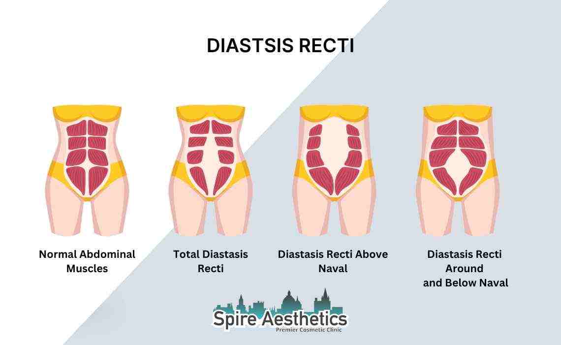 Is Non-Surgical Diastasis Recti Treatment Right for You? Common Concerns Answered Southall